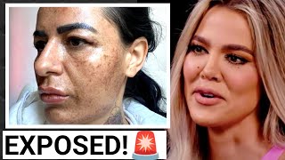 🚨KHLOE KARDASHIAN'S Shocking Skin Cancer Surgery:🚨 The Hidden Truth Revealed!🚨