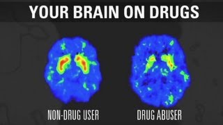 How addiction changes your brain
