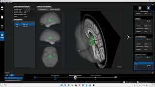 sEEG Electrode Placement with iEEG Montage Creator in the g.tec Suite 2020 Software