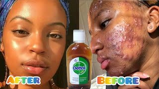 How To Use Dettol Antiseptic Liquid To Clear Acnes | How to get rid of pimples with Dettol