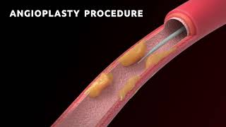 Penile Angioplasty: The Best Treatment for Erectile Dysfunction