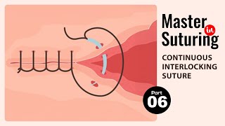 Continuous Interlocking Suture Like a Pro – Learn Suturing Technique