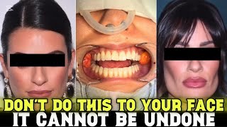 Buccal Fat Removal Regrets: The Truth Behind Chiseled Faces Gone Wrong