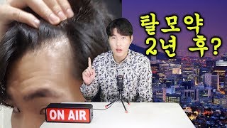 탈모약 2년 먹으면 머리가 자랄까?(M자 탈모,프로페시아,피나스테리드)