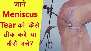 Meniscus tear cause, prevention and treatment in one video in Hindi with English cc