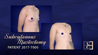 Transgender female to male. Subcutanous mastectomy Before & After [ result]