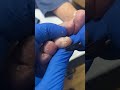 watch aussie podiatrist skillfully remove toe callus foothealth podiatrymagic