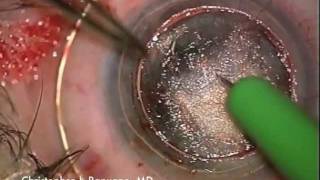 Deep Anterior Lamellar Keratoplasty (DALK)