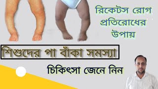 শিশুদের হাড়ের বক্রতা/ রিকেটস হলে কি করনীয় /rickets.