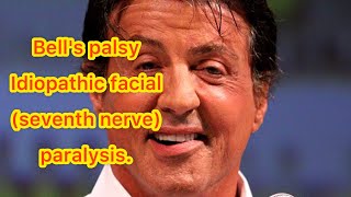 فلج بل-Bell's palsy-تشخیص و درمان