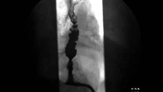 Esophageal Dysmotility with large Sliding Hiatal Hernia