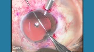 ESCRS Video of the Month 02 - Post traumatic aniridia \u0026 aphakia