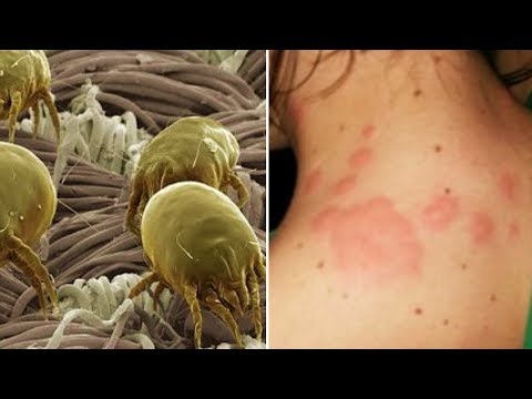 How To Get Rid of Scabies Mites Within 24 Hours How To Get Rid of Scabies Mites Within 24 Hours