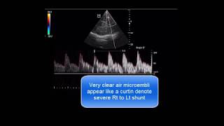 Amazing TCD bubble test to diagnose Rt to Lt shunt