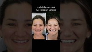 10 Porcelain Veneers made in Australia #brisbane #goldcoast #dentist #ipswich #fashion