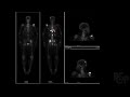 Bone scans in nuclear medicine - RSCP Video Curriculum