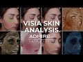 VISIA Skin Analysis in Scottsdale, AZ — AdmireMD Skin Clinic