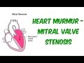 Mitral Stenosis - Auscultation Sound