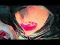 c section previous 5 iud uterine rupture and cesarean hysterectomy done in 15 minutes