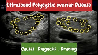 Polycystic Ovaries PCO || Ultrasound | Polycystic Ovarian Syndrome PCOS | Diagnosis | Grading