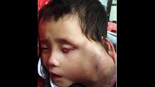 【閲覧注意】両親が“安楽死を願うほどの”巨大腫瘍を抱えた4歳児