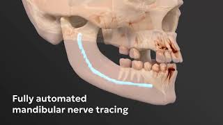 DTX Studio Clinic: Plan your implant treatment and prepare your surgical template in under 3 minutes