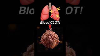 Doctor Explains: PULMONARY EMBOLISM 🫁💥