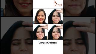 Dimple Creation Surgery in Delhi | Dimple Surgery Before and After #short #shortsfeed