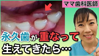 【5歳6歳】下の前歯の永久歯が重なって生えてくる原因と対処法【乳歯が早く抜ける方法も解説】