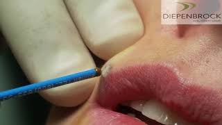 Mole Removal with Ellman RF