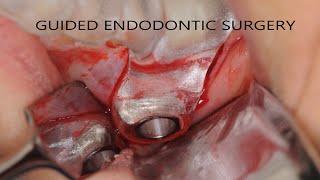 Guided Endodontic Microsurgery with G.Carrieri, P. Villa, M.Rigolone Technique