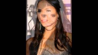 Nina Dobrev Plastic Surgery Before and After