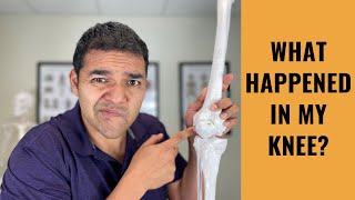 What Happened Inside Your Painful Bone On Bone Knee Joint?