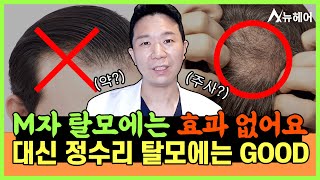 정수리 탈모치료 효과 보는 방법 알려드립니다ㅣ뉴헤어