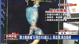 驚! 心臟掉到肚子? 原來是「腹主動脈瘤」－民視新聞