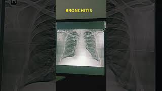 XRAY CHEST PA (BVM) BOTH LUNG FEALD