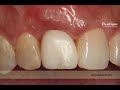 dentium foghúzást követő azonnali implantáció