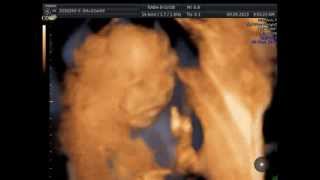 碩碩(Boy) 4D超音波掃描 (4D Ultrasound)