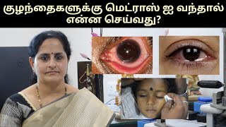 குழந்தைக்கு மெட்ராஸ் கண் தொற்று வந்தால் என்ன செய்வது?#madraseye #eyeinfection #viral