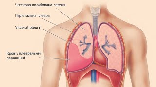 Дренування плевральної порожнини. Медична рота 5 ОШБр. #медицина #війна_в_україні #медики