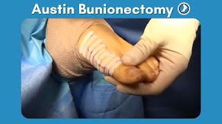 Austin Bunionectomy with Aesthetic Incision