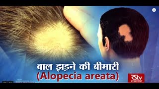 Ayushman Bhava : Alopecia Areata - Patchy Hair Loss | बाल झड़ने की बीमारी | Treatment & Cure