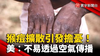 猴痘擴散引發擔憂！美CDC：不易透過空氣傳播 @globalnewstw