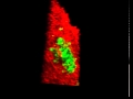 Beata Sikorska  amyloid plaques in GSS