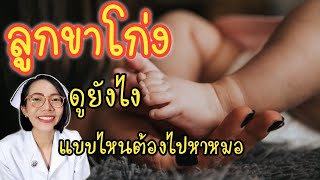 ลูกขาโก่งดูยังไง ใส่แพมเพิส อุ้มลูกเข้าข้างยิ่งขาโก่ง? ดัดขาช่วยไหม|Nurse Kids