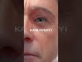 male blepharoplasty ⭕️ kaminskyi