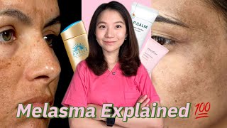 Essential Steps to Treat Melasma