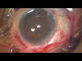 hard black subluxated advanced cataract managed by sics and controversial fixation of iol