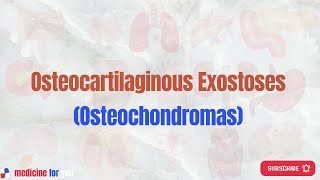 Osteocartilaginous Exostoses (Osteochondromas)