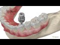 bego semados universal abutment no hex